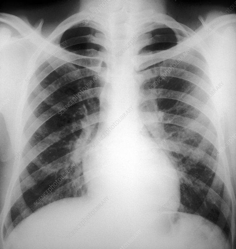 صورة توضيحية تظهر الفرق بين شعب هوائية طبيعية (يمين) وأخرى ملتهبة ومتضيقة مع زيادة في المخاط (يسار) كما في حالة التهاب الشعب الهوائية المزمن.